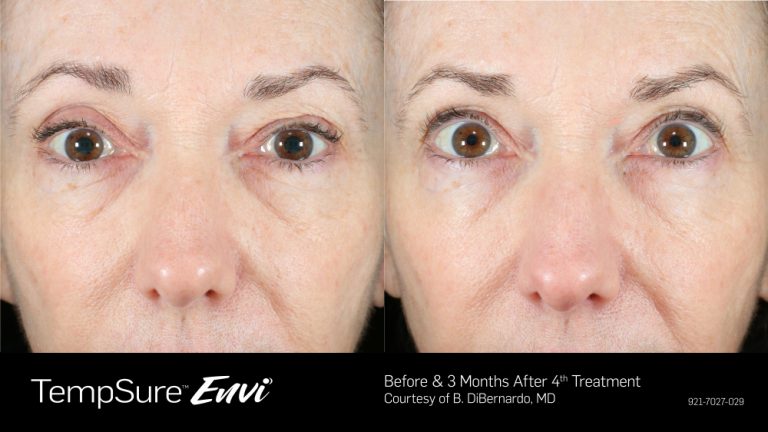 TempSure Envi Eyes Before and After