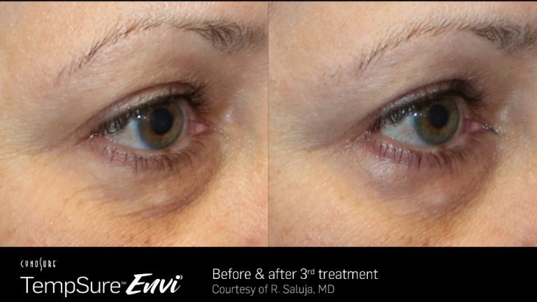 TempSure Envi Eyes Before and After