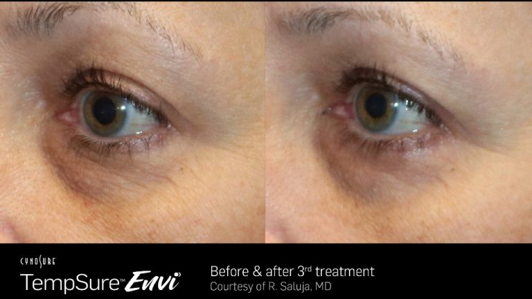 TempSure Envi Eyes Before and After