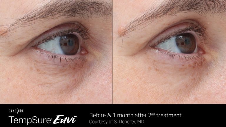 TempSure Envi Eyes Before and After